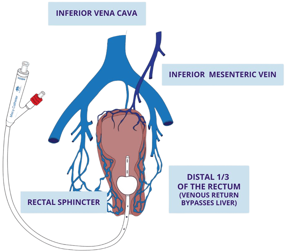 A diagram showing how the Macy Catheter works